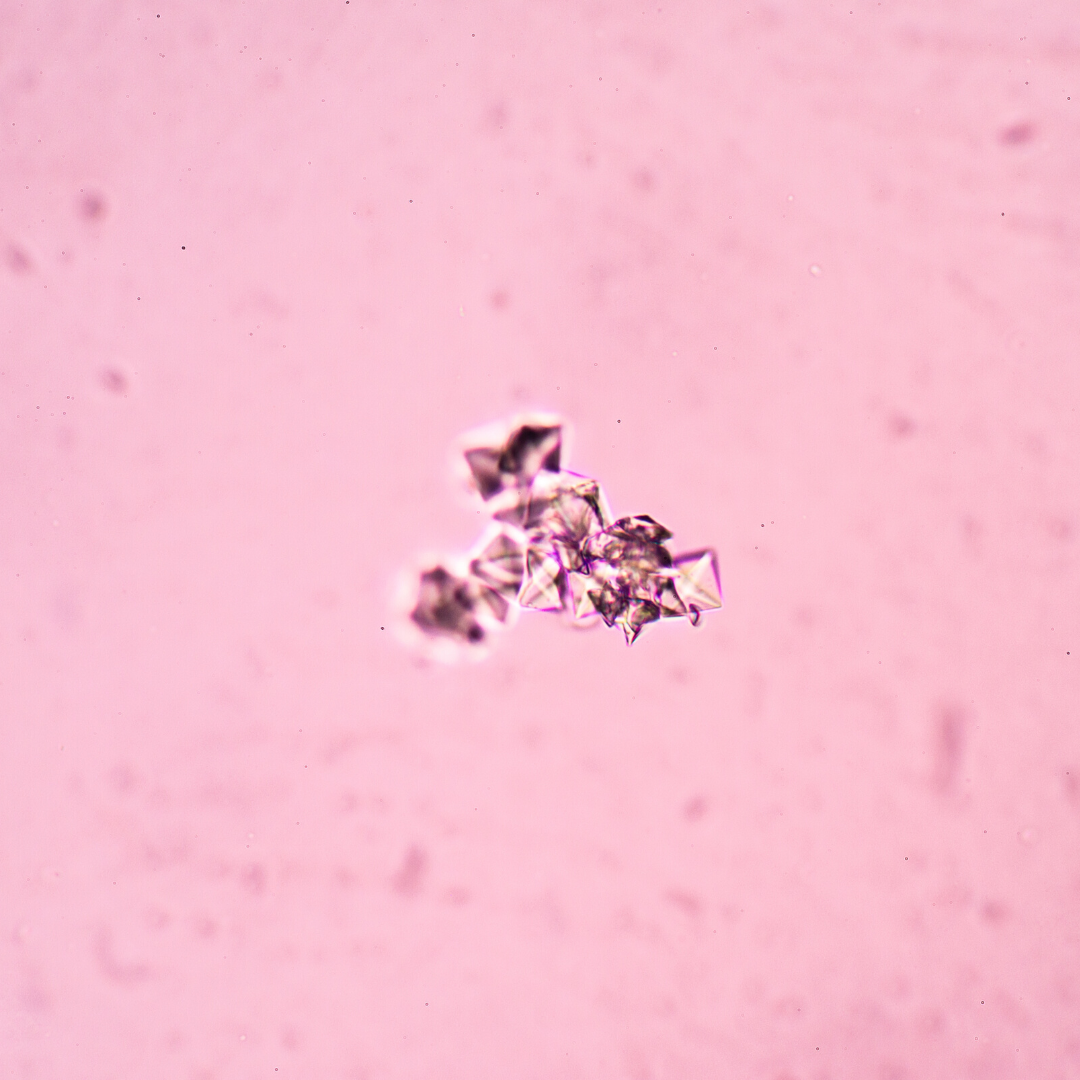 Струвиты и оксалаты. Оксалаты в моче под микроскопом. Оксалаты в микроскопе. Оксалат кальция под микроскопом. Кристаллы кальция в моче у мужчин